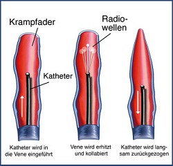 Krampfadern-Venenstau.Katheter